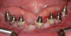 Fig 14. After removing the prosthesis, presence of peri-implant plaque and calculus.