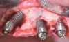 Fig 16. Treatment of peri-implantitis: access flap with exposed implant surfaces after being decontaminated.