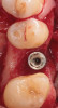 Fig 20. Treatment of peri-implantitis: occlusal view of peri-implant three-wall defect after thorough implant debridement.