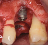 Fig 21. Frontal view of peri-implant three-wall defect after thorough implant debridement.