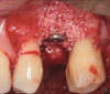 Fig 22. Peri-implant defect filled with a bone replacement graft.