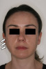 Fig 1. Frontal full-face photograph showing right parotid gland swelling (arrows).