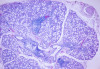 Fig 8. Histopathologic appearance of minor salivary gland biopsy (hematoxylin–eosin). Lower-power magnification showing focal periductal lymphocytic infiltrate (x40).