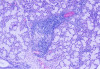 Fig 9. Histopathologic appearance of minor salivary gland biopsy (hematoxylin–eosin). High-power magnification (x100).