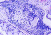 Fig 10. Histopathologic appearance of minor salivary gland biopsy (hematoxylin–eosin). Acinar degeneration (x200).