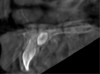 Fig 1. A 0.2-mm thick sagittal image at the level of the upper left central incisor (tooth No. 9) of a 7-year-old boy who presented with a mesodont. Movement artifacts were present as evidenced by double contours and an overall blurring of the image.