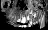 Fig 4. Frontal shaded surface rendering of the patient in Fig 1 after implementation of the algorithm. The threshold of the image remains on the default value. The improvement in image quality is subtle.