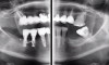 Fig 2. Preoperative radiograph.