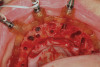 Fig 6. Clinical use of printed bone reduction guide.