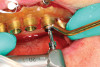 Fig 8. Clinical use of printed stacked drilling guide.