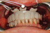 Fig 10. Clinical try-in of printed stacked provisional prosthesis.