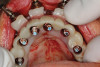 Fig 12. Provisional seated over implant copings.