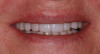 Fig 14. Patient’s smile 5 months post-surgery.