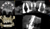 Fig 15. CBCT x-rays 5 months post-surgery.