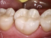 Fig 6. Tooth No. 30, postoperative.