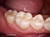Fig 8. Six-month recall image of restoration.