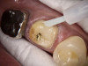Fig 13. Universal bond was applied to the tooth.
