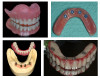 Fig 1. A removable complete denture (upper left); implant and soft-tissue–supported removable implant prosthesis (upper right). Implant-retained and implant-supported removable prosthesis (lower left); fixed screw-retained all-zirconia prosthesis (lower right).