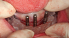 Fig 2. Duplicate denture used as a surgical guide for placing implants.