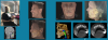 Fig 5. Implant planning accomplished on the implant planning software using the data from the CBCT and facial scans and the intraoral scan (CS 9600 and CS 3700 IOS, Carestream Dental).