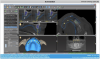 Fig 9. Implant planning done on the implant planning software.