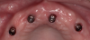 Fig 11. Overdenture attachments attached to the implants (LOCATOR R-Tx, Zest Dental Solutions).