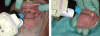 Fig 16. Attachment pickup material was placed around the attachments in the mouth (left) and in the recesses of the prosthesis (right).