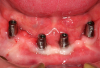 Fig 20.  Abutments were attached to implants in the mouth (Atlantis Conus abutments, Dentsply Sirona).