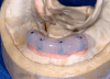 Fig 21. A jig was provided to optimally position the abutments intraorally.