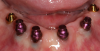 Fig 28. The denture attachment housings (pink) were placed over the four anterior abutments.