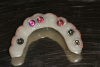Fig 36. The three denture attachment housings (pink) were picked up in the all-zirconia prosthesis.