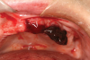 Fig 1. Liver clots form due to incomplete fibrin clotting. Here, liver clots formed at sites Nos. 9 and 11 after implant placements. The liver clot on No. 8 was removed.