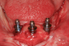 Fig 5. The center implant was used as a “cork in the bottle” to stop bleeding from an osteotomy created over the lingual foramen. The bleeding was so strong it pushed the guide pin out of the osteotomy.