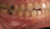 Fig 1. and Fig 2. Multiple carious posterior teeth after use of e-cigs. Fig 1: Gross caries on maxillary and mandibular right first molars; Fig 2: Gross buccal caries on a mandibular left first molar. (Reprinted with permission from Journal of Esthetic and Restorative Dentistry.28 Copyright 2020, John Wiley and Sons).