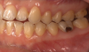 Fig 1. and Fig 2. Multiple carious posterior teeth after use of e-cigs. Fig 1: Gross caries on maxillary and mandibular right first molars; Fig 2: Gross buccal caries on a mandibular left first molar. (Reprinted with permission from Journal of Esthetic and Restorative Dentistry.28 Copyright 2020, John Wiley and Sons).