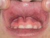 Fig 3. Upper labial mucosa and maxillary vestibular gingiva showing widespread shallow ulceration, erosion, and erythema after use of e-cigs that included marijuana. (Reprinted with permission from Pediatric Dermatology.30 Copyright 2020, John Wiley and Sons) 
mandibular right first molars; Fig 2: Gross buccal caries on a mandibular left first molar. (Reprinted with permission from Journal of Esthetic and Restorative Dentistry.28 Copyright 2020, John Wiley and Sons)