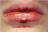 Fig 4. Oral injuries after e-cig explosion. Fig 4: Laceration of the lower lip vermillion with ecchymosis; Fig 5: Multiple lacerations with surrounding erythema on the upper labial mucosa; Fig 6: Hematoma of the lower labial mucosa with small midline ulceration; Fig 7: Resultant dental injuries included complete intrusion of tooth No. 7, avulsion of tooth No. 8, fracture of tooth No. 9 to the gingival margin, and incisal fracture of tooth No. 10. (Reprinted with permission from Journal of Oral and Maxillofacial Surgery.37 Copyright 2016, Elsevier)