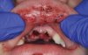 Fig 5. Oral injuries after e-cig explosion. Fig 4: Laceration of the lower lip vermillion with ecchymosis; Fig 5: Multiple lacerations with surrounding erythema on the upper labial mucosa; Fig 6: Hematoma of the lower labial mucosa with small midline ulceration; Fig 7: Resultant dental injuries included complete intrusion of tooth No. 7, avulsion of tooth No. 8, fracture of tooth No. 9 to the gingival margin, and incisal fracture of tooth No. 10. (Reprinted with permission from Journal of Oral and Maxillofacial Surgery.37 Copyright 2016, Elsevier)