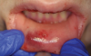 Fig 6. Oral injuries after e-cig explosion. Fig 4: Laceration of the lower lip vermillion with ecchymosis; Fig 5: Multiple lacerations with surrounding erythema on the upper labial mucosa; Fig 6: Hematoma of the lower labial mucosa with small midline ulceration; Fig 7: Resultant dental injuries included complete intrusion of tooth No. 7, avulsion of tooth No. 8, fracture of tooth No. 9 to the gingival margin, and incisal fracture of tooth No. 10. (Reprinted with permission from Journal of Oral and Maxillofacial Surgery.37 Copyright 2016, Elsevier)