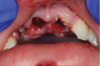 Fig 7. Oral injuries after e-cig explosion. Fig 4: Laceration of the lower lip vermillion with ecchymosis; Fig 5: Multiple lacerations with surrounding erythema on the upper labial mucosa; Fig 6: Hematoma of the lower labial mucosa with small midline ulceration; Fig 7: Resultant dental injuries included complete intrusion of tooth No. 7, avulsion of tooth No. 8, fracture of tooth No. 9 to the gingival margin, and incisal fracture of tooth No. 10. (Reprinted with permission from Journal of Oral and Maxillofacial Surgery.37 Copyright 2016, Elsevier)