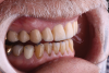 Fig 13. Posterior interferences were removed to allow for posterior disclusion on both the right (Fig 13) and left (Fig 14) sides of the mouth.