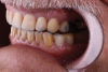 Fig 14. Posterior interferences were removed to allow for posterior disclusion on both the right (Fig 13) and left (Fig 14) sides of the mouth.