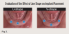 Fig 3. For mandibular overdentures, when the posterior bone has been resorbed, implants (blue dots) are usually placed intraforaminally. In a U-shaped jaw (left), placement of a third implant will not change how the prosthesis functions; the overdenture will still rotate in a non-rigid manner. In contrast, a V-shaped jaw (right) provides an opportunity to place a third implant that will increase the A-P spread and result in a more rigid prosthesis.