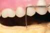 Fig 4. Vertical restorative space is measured from the gingiva (or bone) of the edentulous ridge to the opposing dentition.