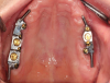 Fig 10. A maxillary bar can be extended off implants to provide better retention of the overdenture.
