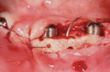 Fig 7. Bone sutures are shown in this photograph. Holes were created in the bone 2 mm from the implant and 2 mm from the crest and connected to allow penetration of a suture. Flaps were snugged down to the bone and primary closure was attained.