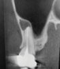 Fig 1. Preoperative CBCT scan showing a sagittal section of nonrestorable tooth No. 2 with a periapical radiolucency.
