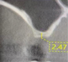 Fig 2. Preoperative CBCT scan showing a sagittal section of pneumatized right maxillary sinus in edentulous site No. 3.