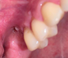 Fig 3. A fistula (Fig 3) and wound dehiscence (Fig 4) were evident at 4-week postoperative follow-up.