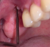 Fig 4. A fistula (Fig 3) and wound dehiscence (Fig 4) were evident at 4-week postoperative follow-up.